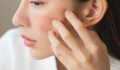 Cilt kuruluğu deyip geçmeyin... Başka hastalıkların habercisi olabilir!